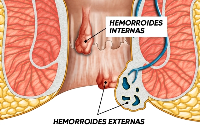 Os 12 Remédios Para Eliminar as Hemorroidas Em Casa