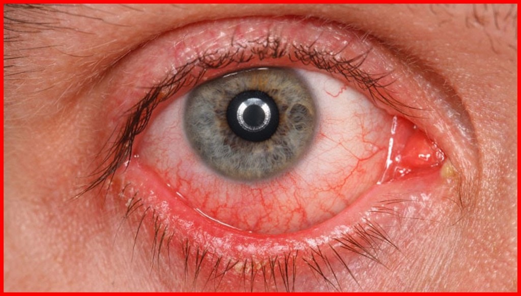 Olhos Vermelhos: os 10 melhores remédios caseiros