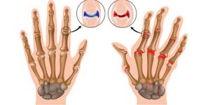 osteoartrite nas maos