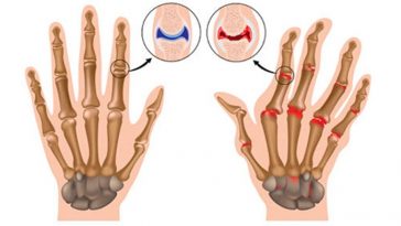 osteoartrite nas maos