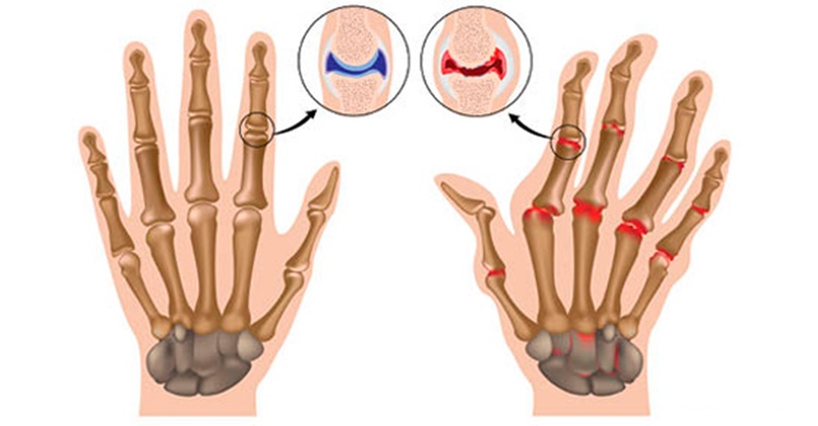 osteoartrite nas maos