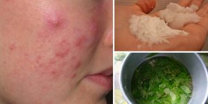 eliminar a acne