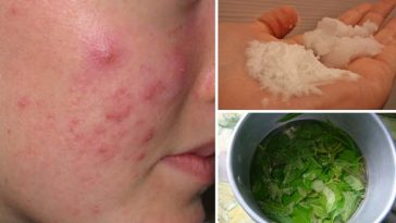 eliminar a acne
