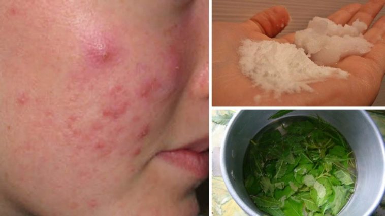 eliminar a acne
