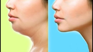 exercícios para eliminar a papada