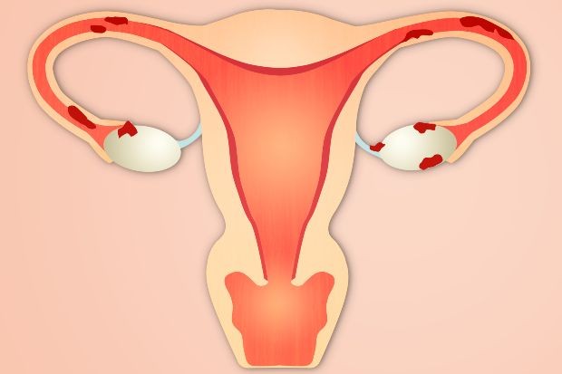 Os 11 Principais Sintomas da Endometriose